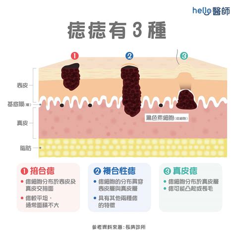 胸部長很多痣|痣形成的原因？痣長毛、痣變多變大是痣病變？5招判別